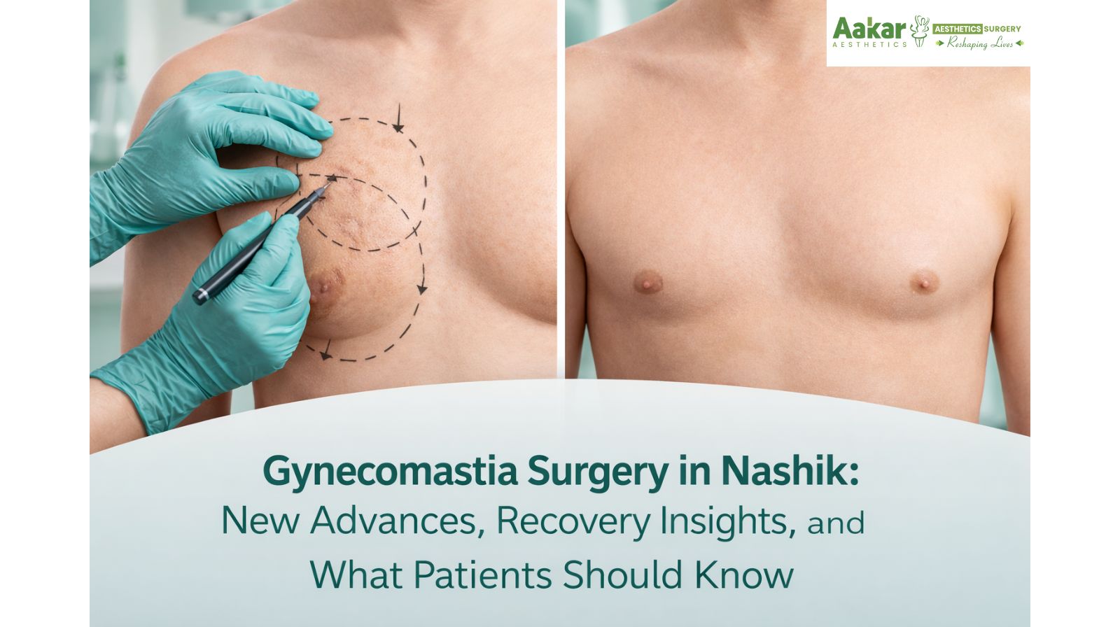 Gynecomastia Removal in Nashik – Safe & Effective Male Breast Reduction Surgery
