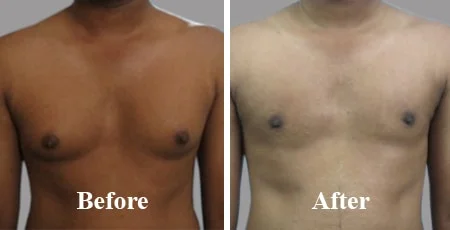 Gynecomastia Surgery in Nashik | Male Chest Reduction
