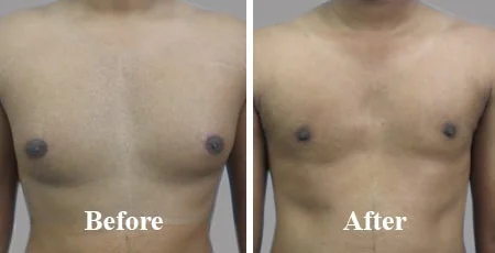 Gynecomastia Surgery in Nashik | Male Chest Reduction