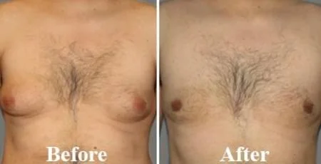 Gynecomastia Surgery in Nashik | Male Chest Reduction