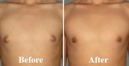Gynecomastia Surgery in Nashik | Male Chest Reduction