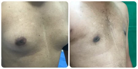 Gynecomastia Surgery in Nashik | Male Chest Reduction